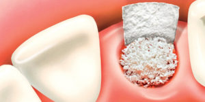 bone-grafting-geelong