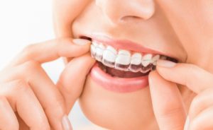 invisalign-treatment-geelong