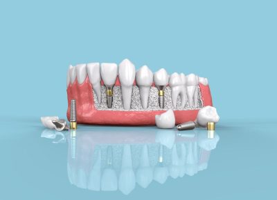 dental-implants-geelong